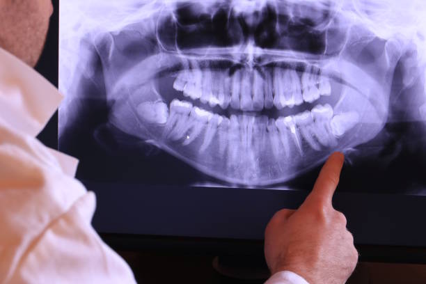 Best Emergency Wisdom Tooth Extraction in Stanhope, NJ